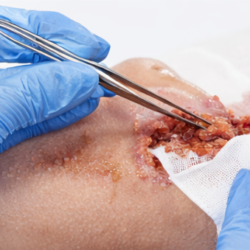Cleansing & Debridement